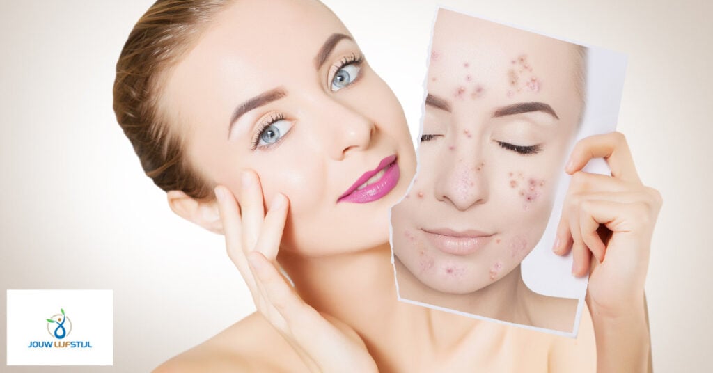 Effectieve Behandelingen voor Beste Acne Creme